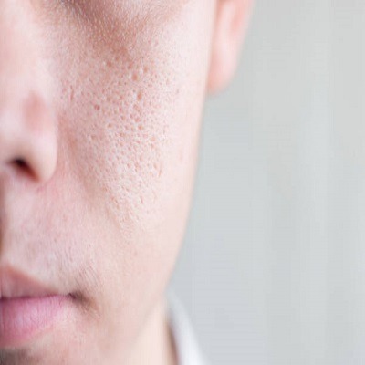 Large Pores