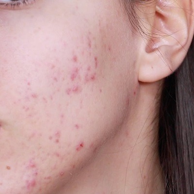 Are Melasma and Pigmentation Removal Treatments Effective in Dubai?